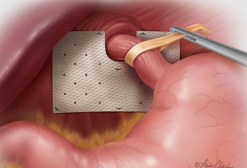 Stomach Hernia head2