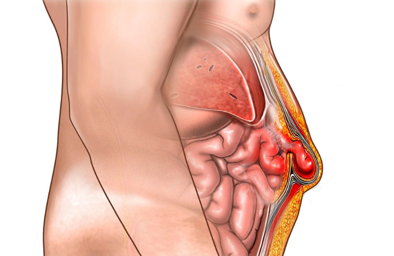 Stomach Hernia head3
