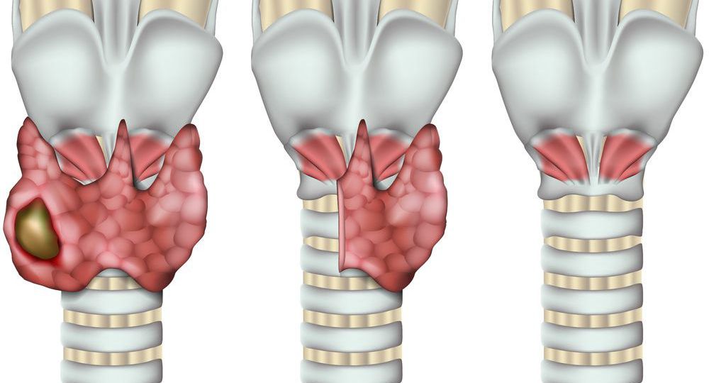 Thyroid Cancer risk head1