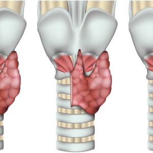 Thyroid Cancer risk head1