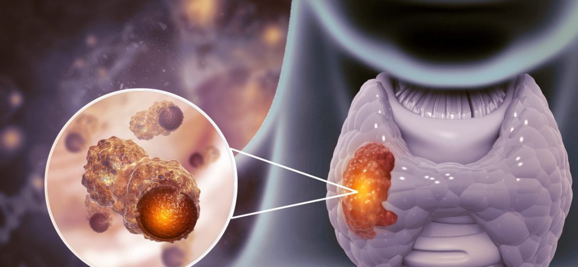 Thyroid Cancerr head2