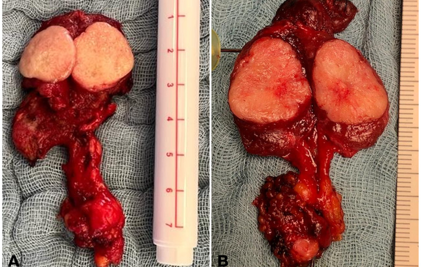 Thyroid Cancerr head4