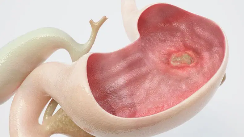 Ulcer HEAD1