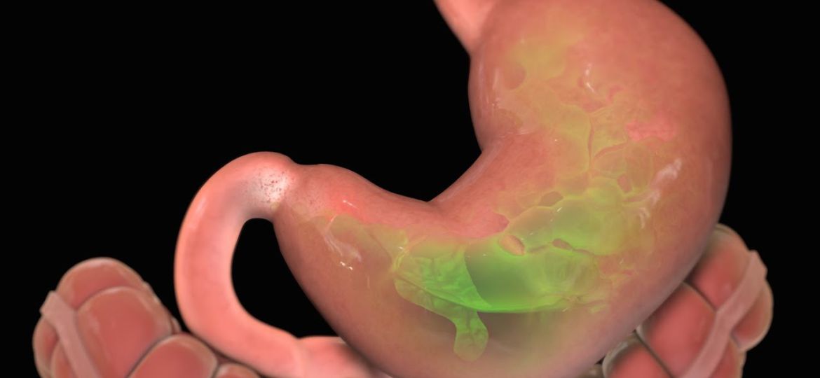 Ulcer HEAD4