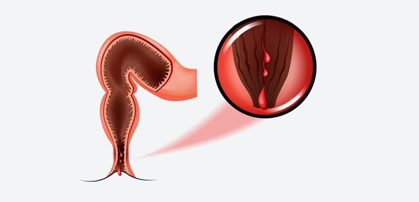 anal fissure head1