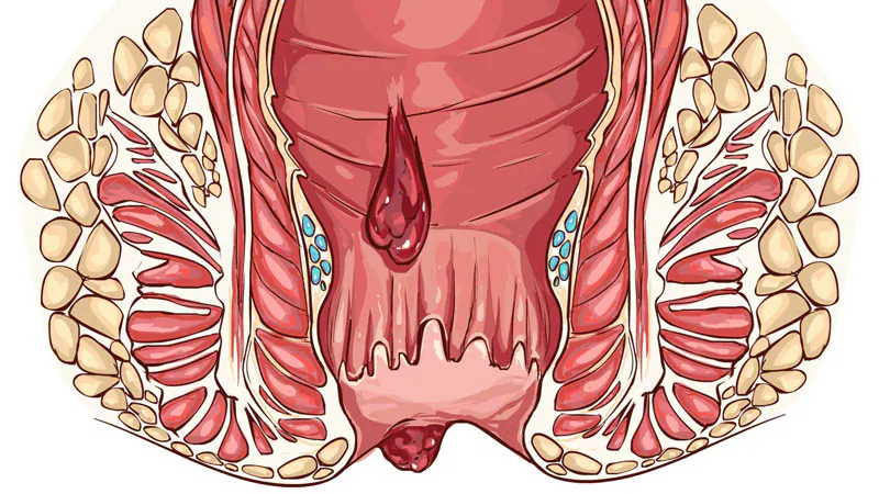 anal fissure head11