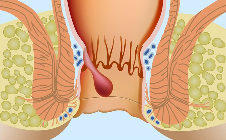 anal fistula head2