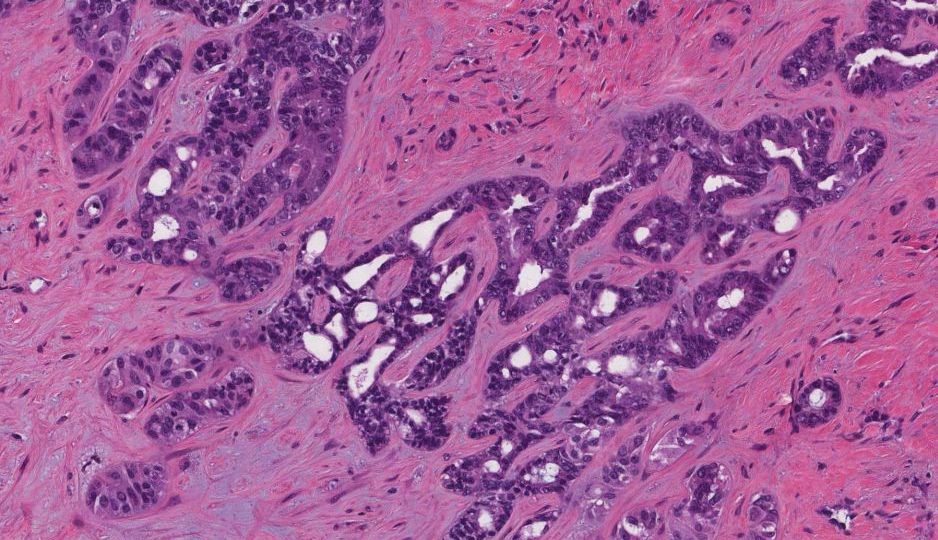 cholangiocarcinoma head1