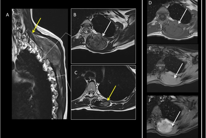 desmoid tumors head 1