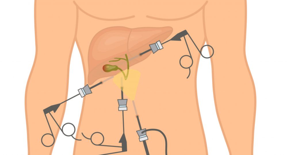 gallbladder stone head3
