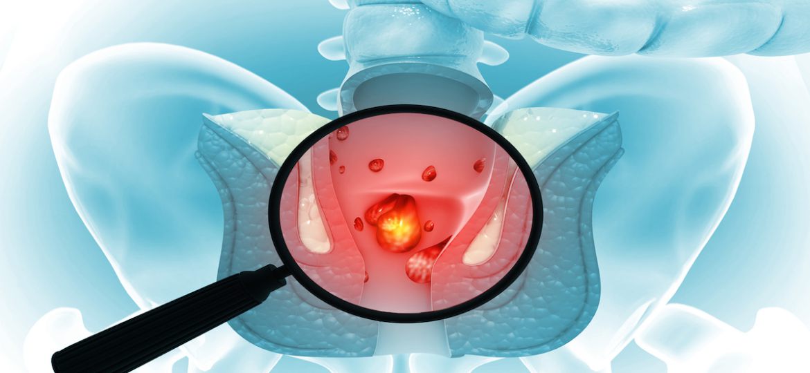 Magnifying glass showing the haemorrhoids (piles) on scientific background. 3d illustration