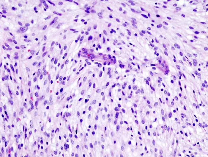 leiomyosarcoma head1