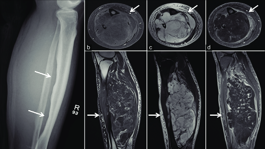 liposarcoma head1