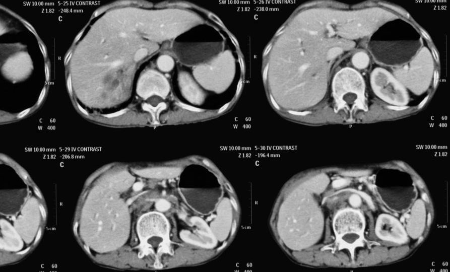 liver adenoma head1