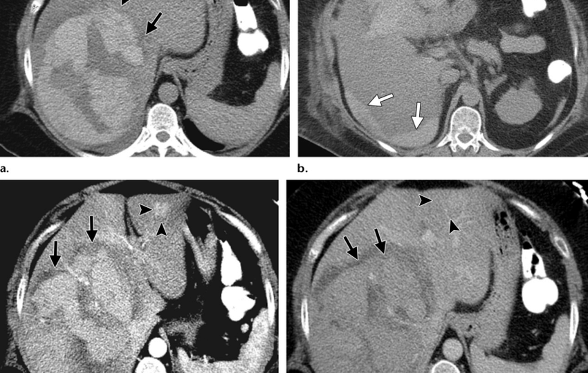 liver adenoma head2