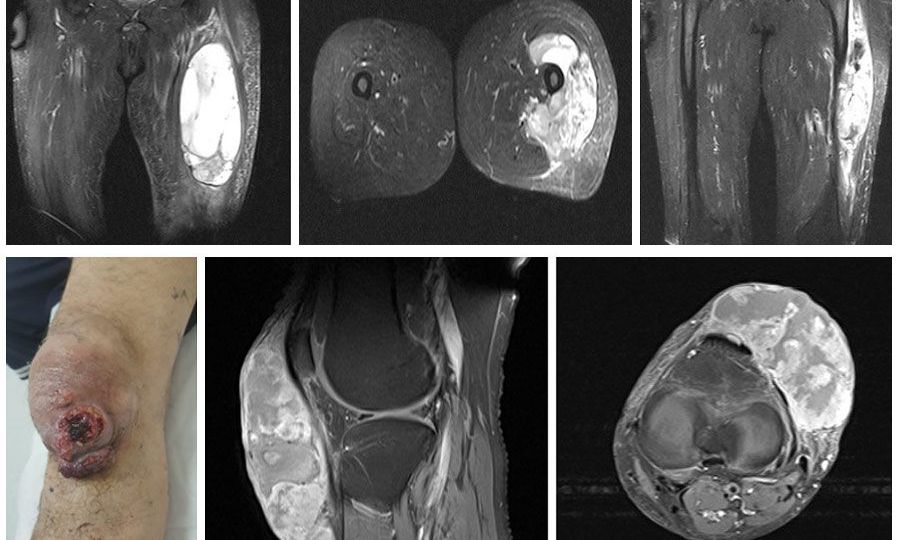 rhabdomyosarcoma head1